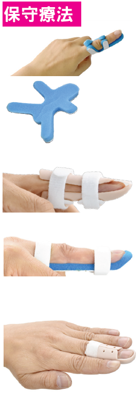 Hammer finger overview